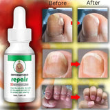 NAILS SERUM FOR NAIL GROWTH & REPAIR, FUNGAL INFECTION, ANTI-INFECTIVE REMOVAL PARONYCHIA ONYCHOMYCOSIS
